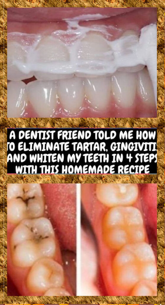 A DENTIST FRIEND TOLD ME HOW TO ELIMINATE TARTAR, GINGIVITIS AND WHITEN MY TEETH IN 4 STEPS WITH THIS HOMEMADE RECIPE