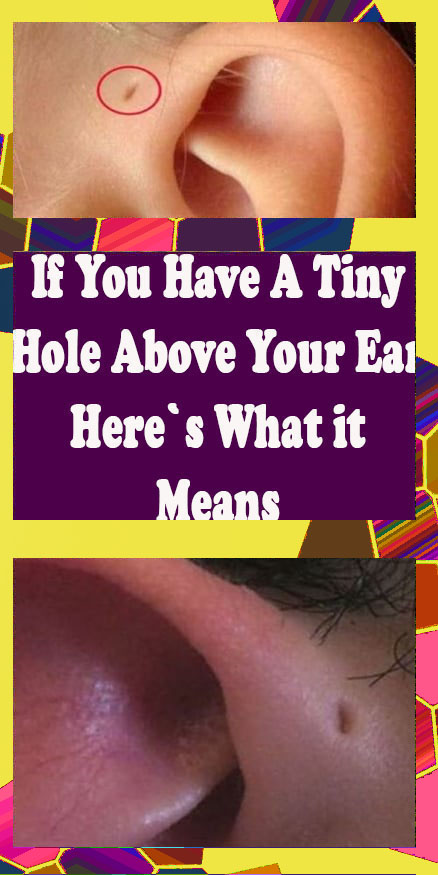 If You Have A Tiny Hole Above Your Ear, Here’s What It Means